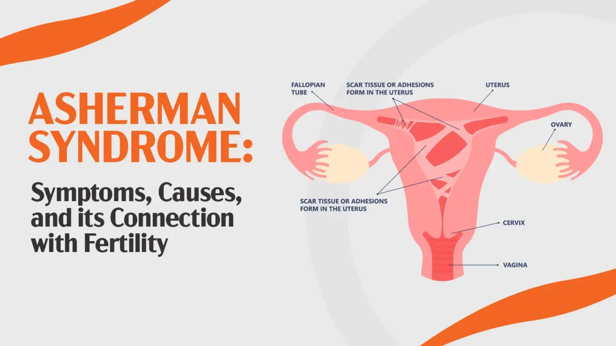 Asherman Syndrome: Symptoms, Causes, and its Connection with Fertility